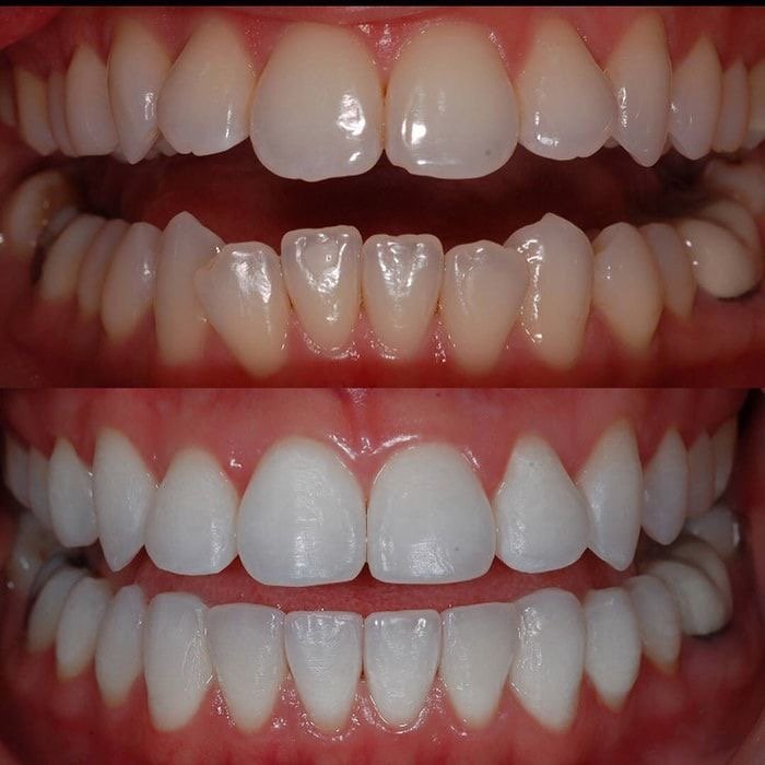 Resultado de clareamento dental - antes e depois