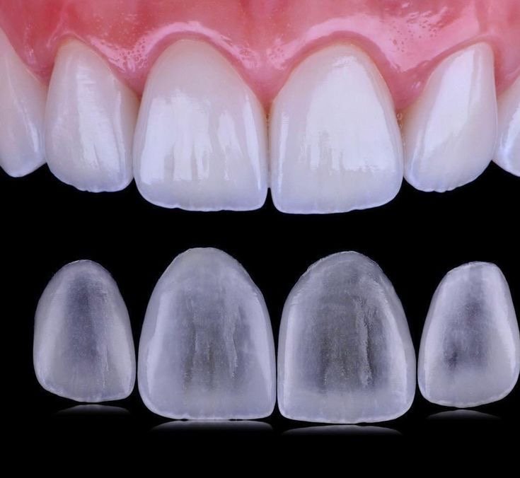 Lentes de contato dental ultrafinas