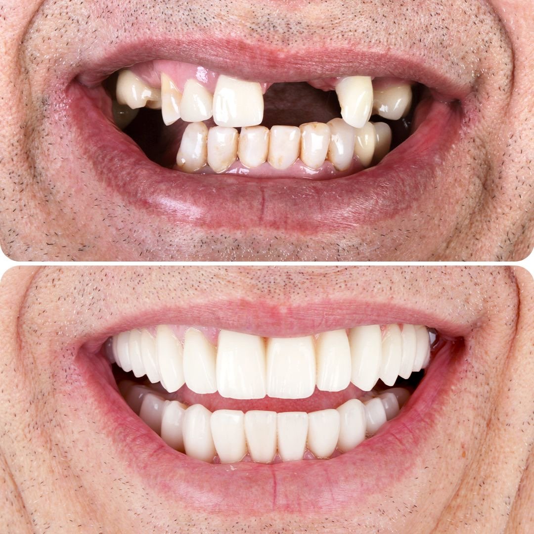 Reabilitação dental — antes e depois