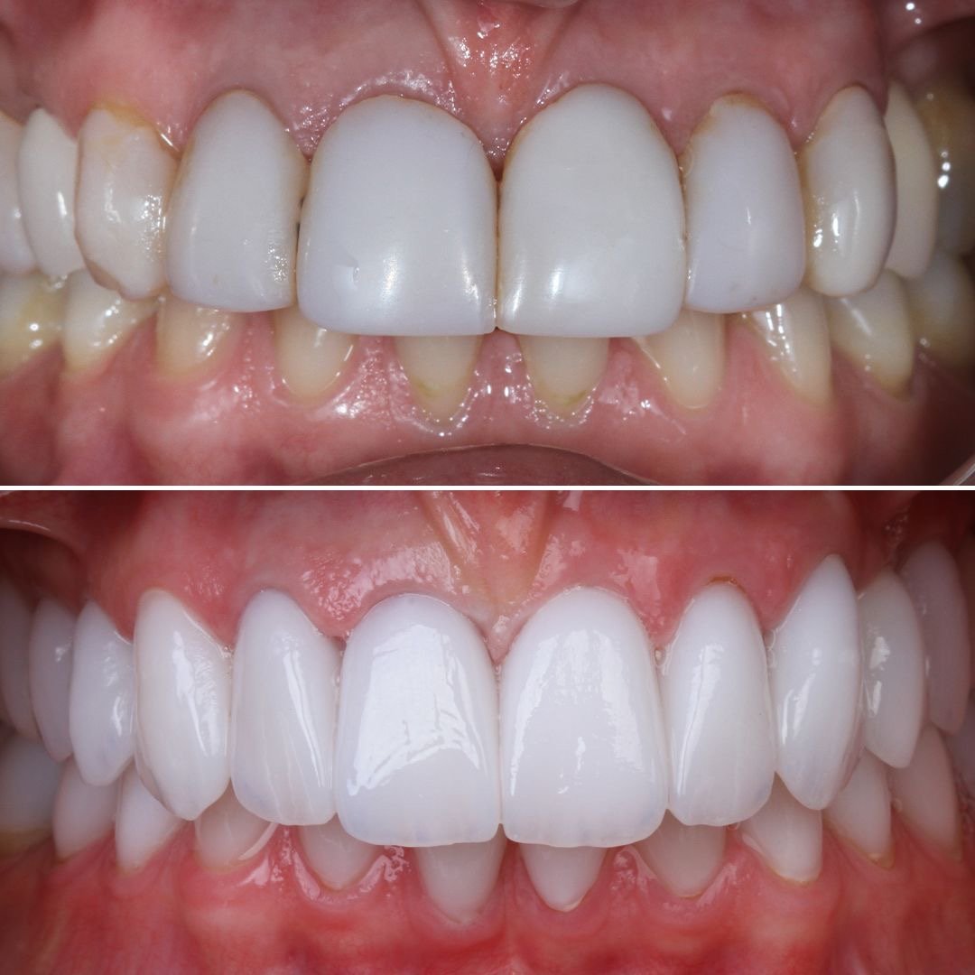 Lentes de contato dental — antes e depois