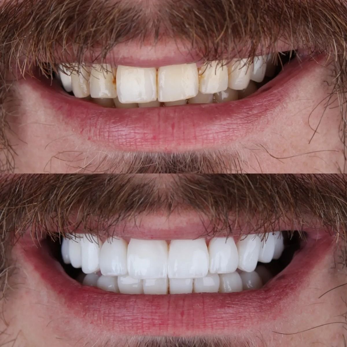 Resultado de lentes dentais em paciente masculino