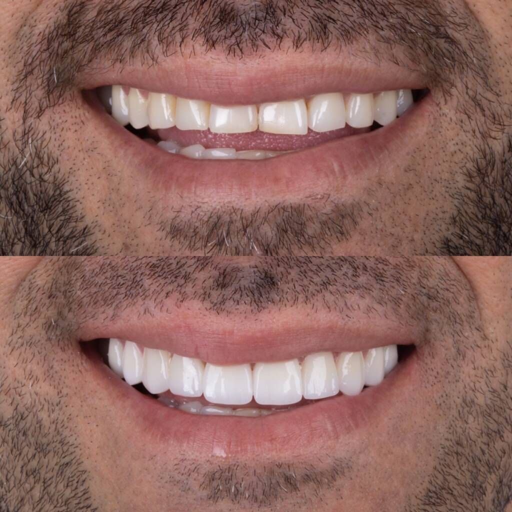 Antes e depois de tratamento estético dental